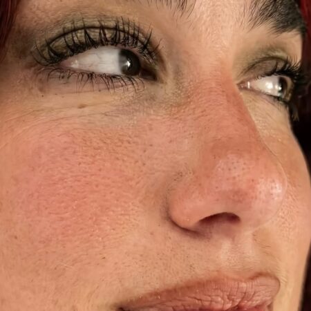 Por que a pele da Dua Lipa se tornou motivo de debate?